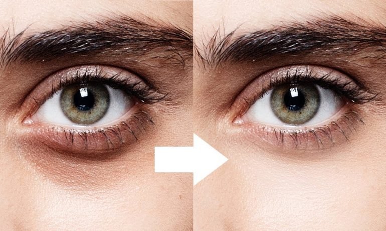 Beauty tips: lightenDark circles