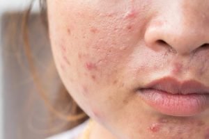 Skin Care 4 Using harsh products