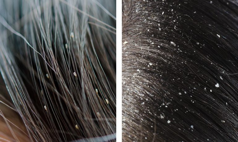 dandruff